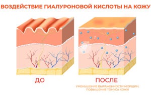 Гиалуроновая кислота действие