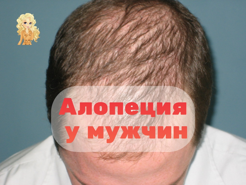 Алопеция у мужчин